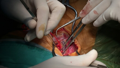 carotid artery surgery near me